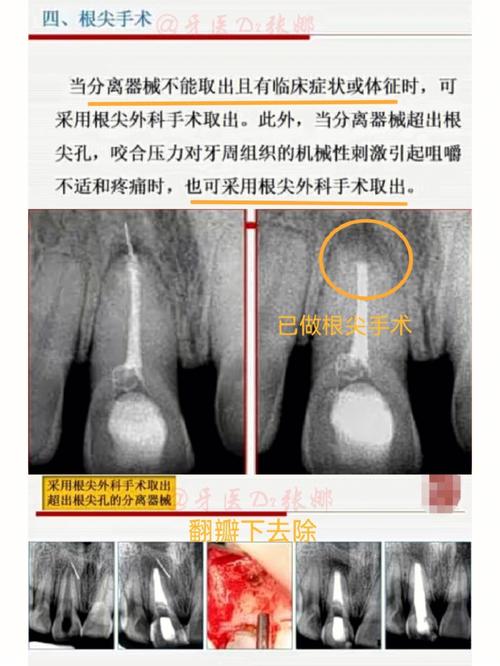 牙科治疗中器械意外折断在牙齿内部，医生会采用哪些专业方法安全取出断针？患者会有明显疼痛或风险吗？-图2