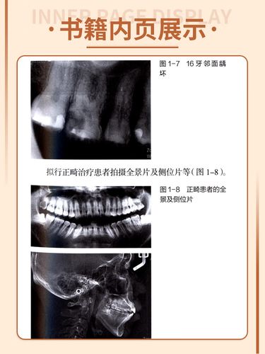 食物嵌塞后，家庭护理（如牙线、冲牙器）与专业治疗（如补牙、牙周治疗）哪种更有效？不同嵌塞程度该如何选择最佳方案？-图1