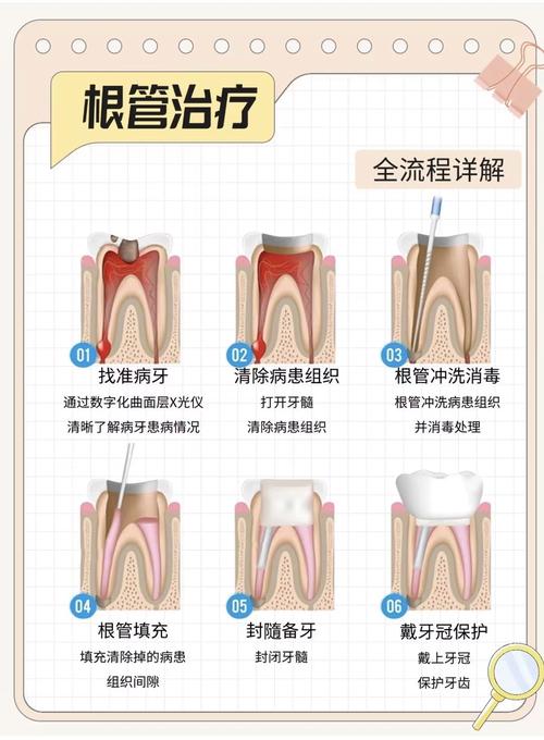 根管治疗的不同方法有哪些？各自适用什么牙齿情况？效果和优缺点如何？-图2