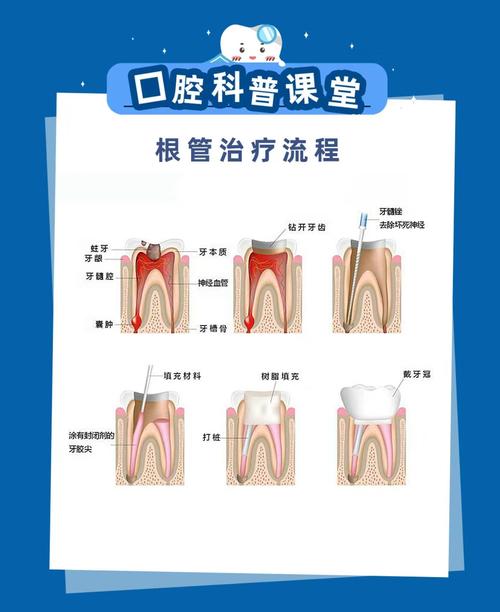 根管治疗的不同方法有哪些？各自适用什么牙齿情况？效果和优缺点如何？-图3