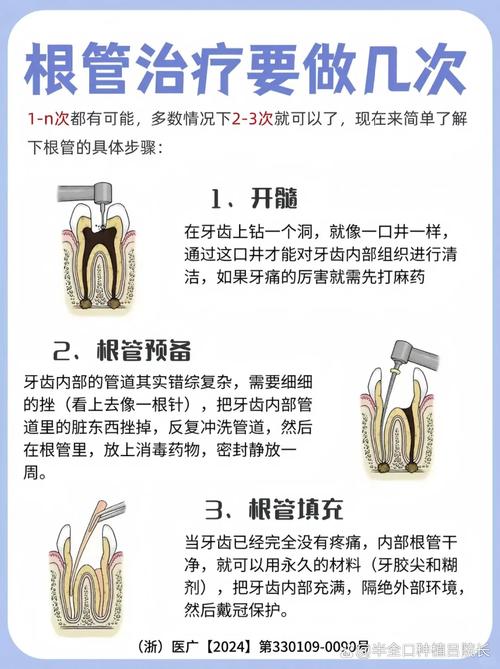 根管治疗的不同方法有哪些？各自适用什么牙齿情况？效果和优缺点如何？-图1