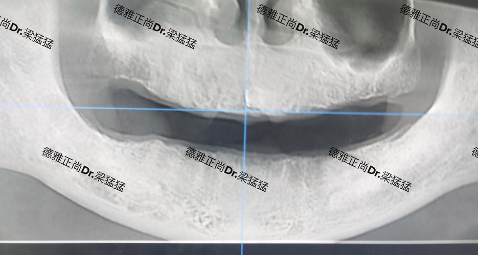 德国种植牙的技术和材料质量到底怎么样？使用寿命、术后效果有哪些优势，价格是否值得选择？-图1