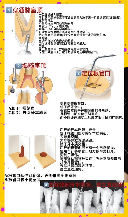 根管携热器使用方法详解，从操作步骤到注意事项，如何确保治疗安全有效？-图2
