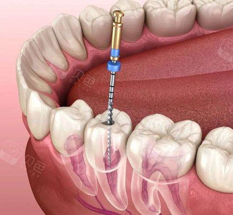 根管携热器使用方法详解，从操作步骤到注意事项，如何确保治疗安全有效？-图3