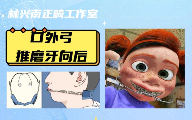 正畸口外弓睡觉时能直接戴着睡吗？需要固定装置防止脱落吗？侧睡会不会压到脸颊影响矫正效果？-图2