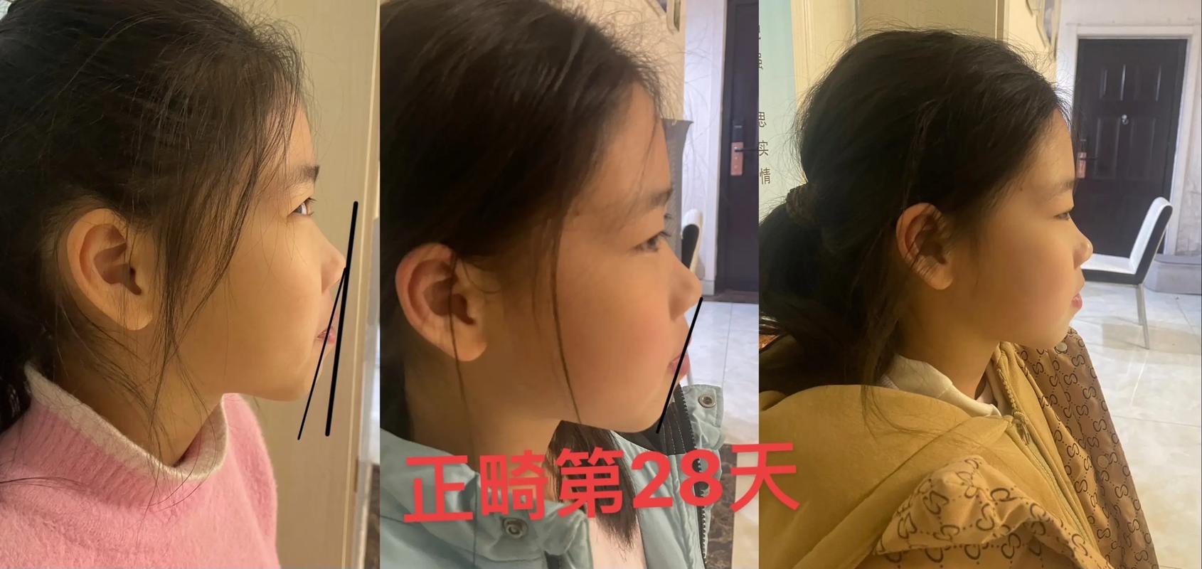 正畸口外弓睡觉时能直接戴着睡吗？需要固定装置防止脱落吗？侧睡会不会压到脸颊影响矫正效果？-图1