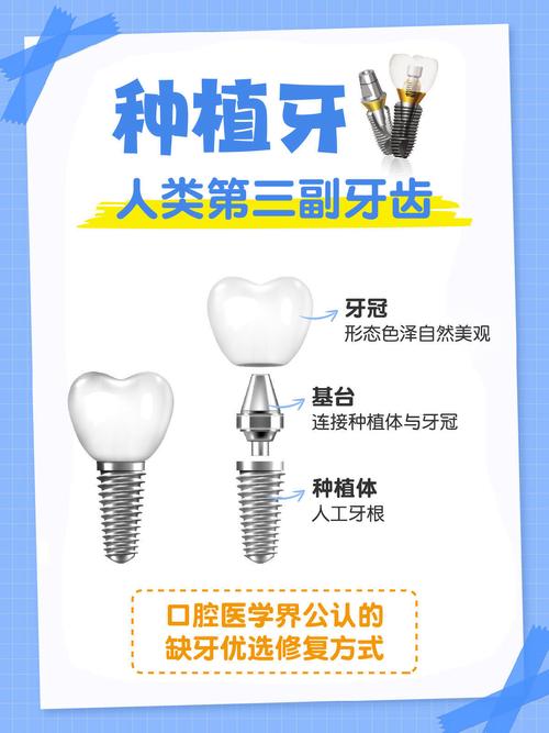 种牙种植体真的能永久使用吗?影响其使用寿命的关键因素有哪些?-图1 种牙种植体真的能永久使用吗?影响其使用寿命的关键因素有哪些?-图1