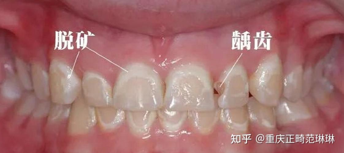 蛀牙严重到什么程度就不能做正畸？必须先治好蛀牙才能戴牙套矫正吗？-图2