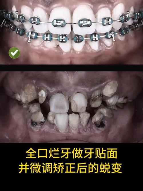蛀牙严重到什么程度就不能做正畸?必须先治好蛀牙才能戴牙套矫正吗?-图1 蛀牙严重到什么程度就不能做正畸?必须先治好蛀牙才能戴牙套矫正吗?-图1