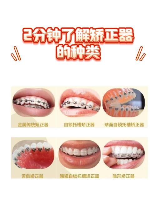 II类颌畸形矫正方法有哪些?不同矫正方式适用人群和效果差异如何?-图3 II类颌畸形矫正方法有哪些?不同矫正方式适用人群和效果差异如何?-图3