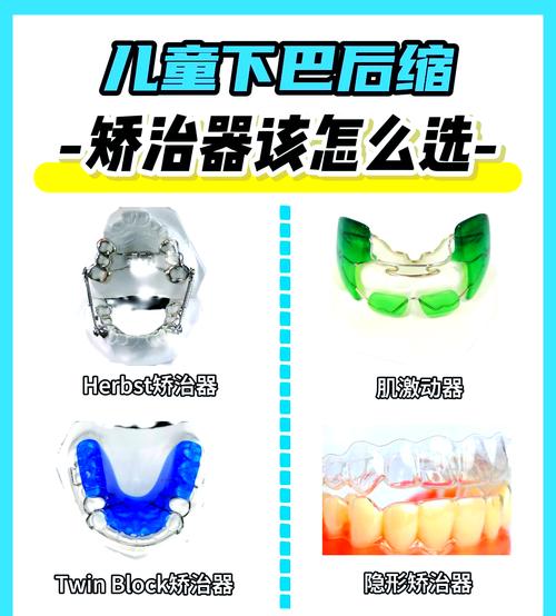 II类颌畸形矫正方法有哪些?不同矫正方式适用人群和效果差异如何?-图1 II类颌畸形矫正方法有哪些?不同矫正方式适用人群和效果差异如何?-图1