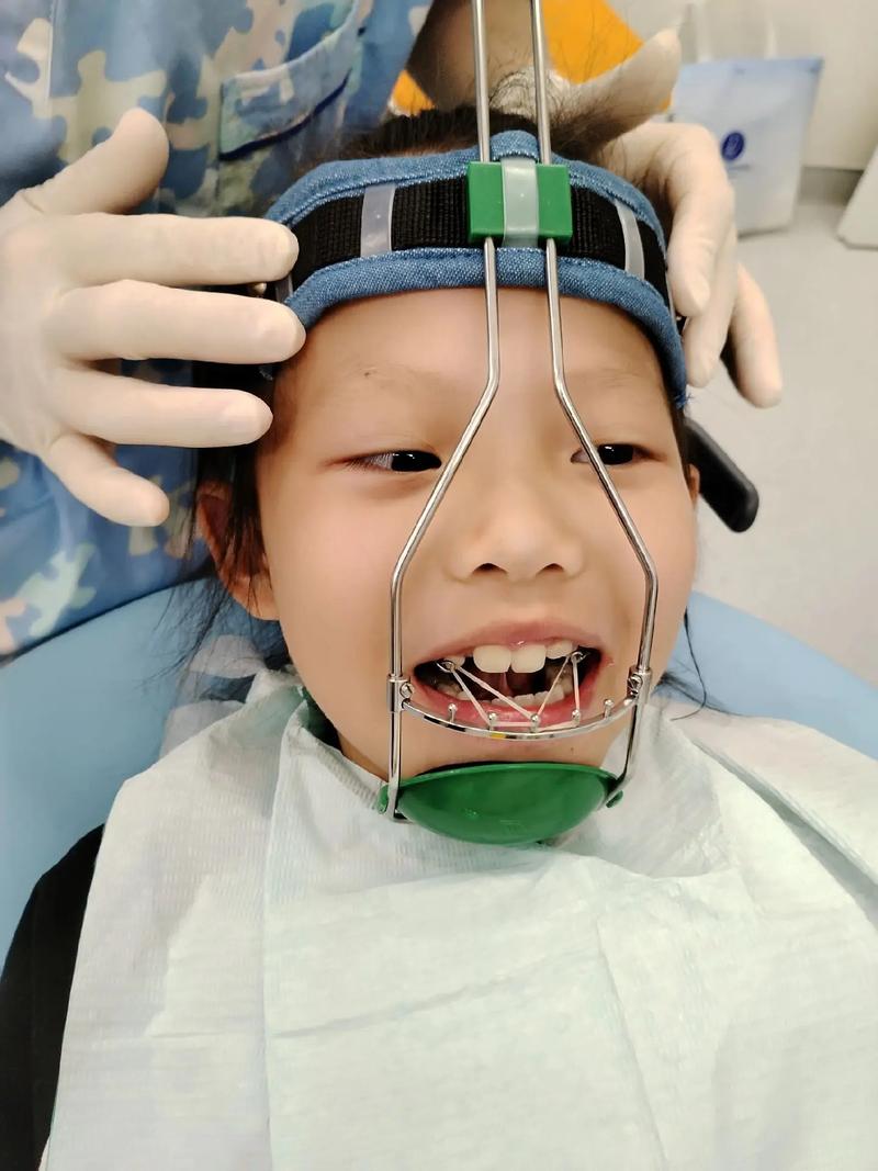 幼儿反颌矫正应在什么年龄段开始？有哪些安全有效的矫正方法适合低龄儿童？家长如何配合治疗？-图1