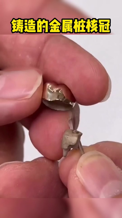 铸造桩核制作过程中，材料选择、蜡型制作与包埋烧结等关键步骤有哪些技术要点？-图3