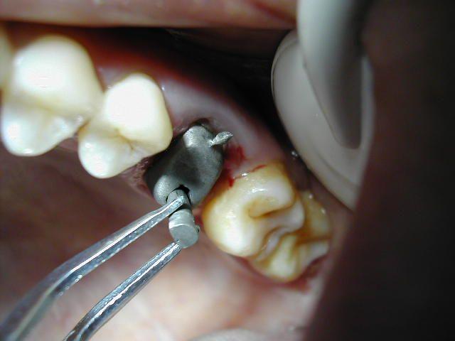 铸造桩核制作过程中，材料选择、蜡型制作与包埋烧结等关键步骤有哪些技术要点？-图2