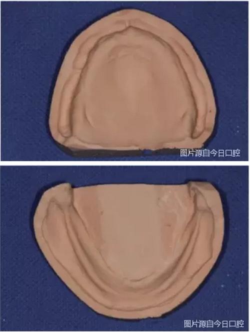 无牙合患者的印模方法有哪些？不同技术如何影响义齿适配性与长期稳定性？-图1