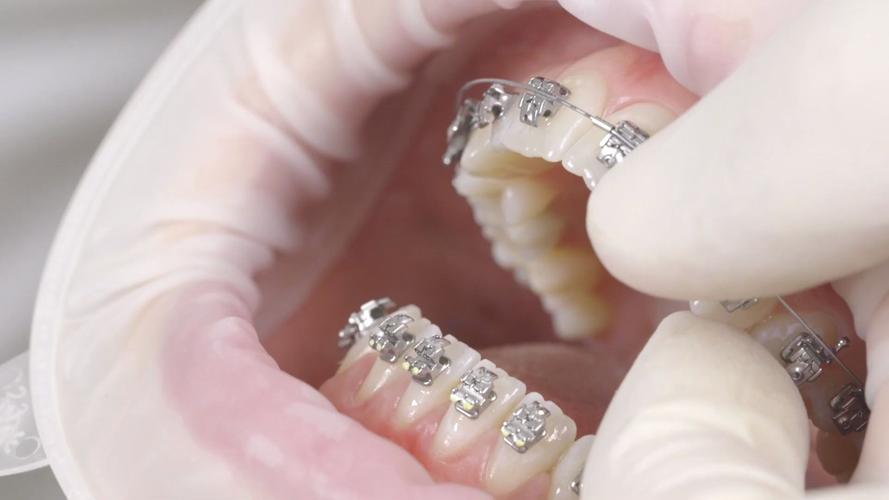 正畸托槽粘接后频繁脱落？影响托槽牢固的关键因素及实用粘接技巧有哪些？-图3