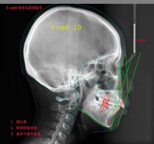正畸头影测量视频讲座中，临床医生如何精准掌握标志点定位与数据分析的核心技巧？-图1
