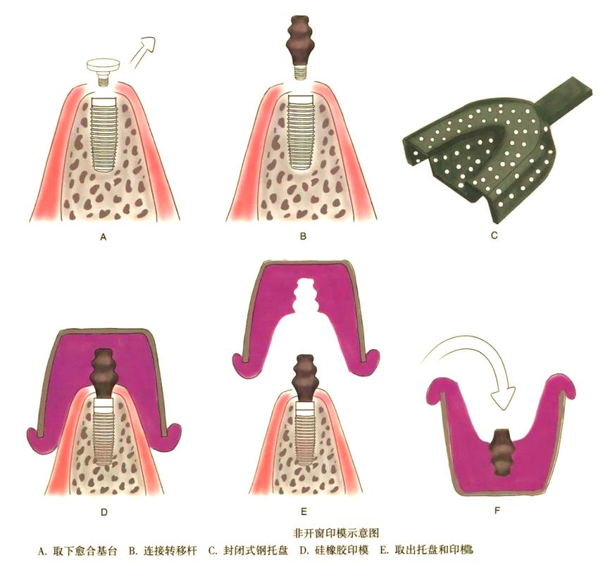 种植体取出有哪些具体方法?不同骨结合状态和种植年限下如何选择术式?-图2 种植体取出有哪些具体方法?不同骨结合状态和种植年限下如何选择术式?-图2