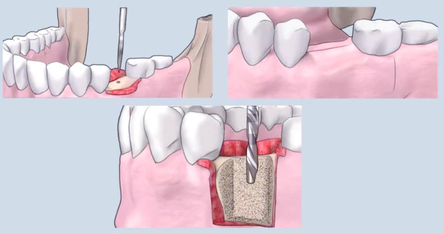种牙置骨粉会疼吗？手术中和术后疼痛感有何不同，如何有效缓解？-图2