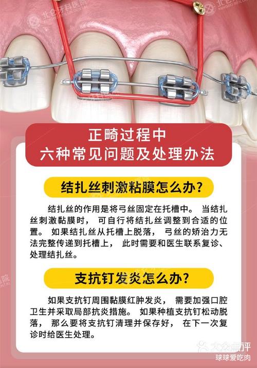 口腔正畸悬吊结扎法图解,操作步骤有哪些?与传统结扎法相比优势在哪?适用哪些错颌畸形病例?-图2 口腔正畸悬吊结扎法图解,操作步骤有哪些?与传统结扎法相比优势在哪?适用哪些错颌畸形病例?-图2