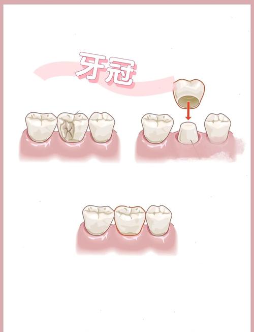 牙齿茜体支配方法具体指什么?其实施步骤和适用场景有哪些?-图2 牙齿茜体支配方法具体指什么?其实施步骤和适用场景有哪些?-图2