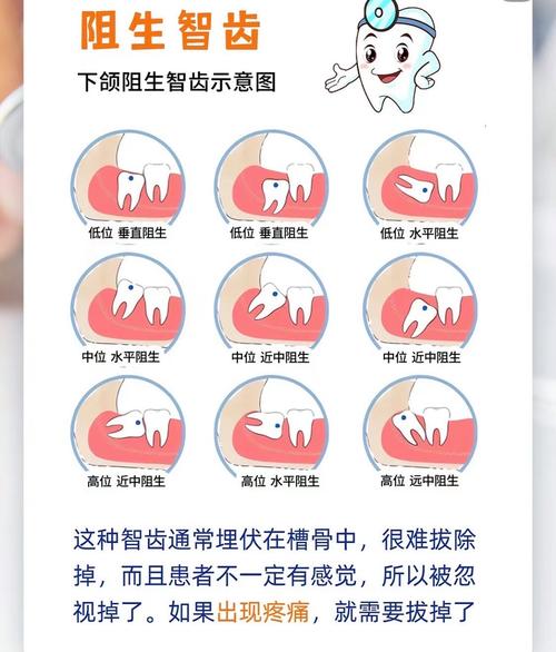 正畸期间拔智齿会影响矫正效果吗？存在哪些风险与最佳拔除时机？-图3