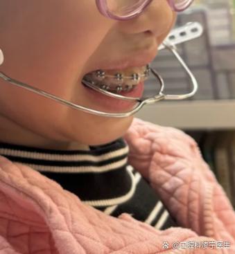 为什么牙齿正畸牵引牙时会特别痛?这种剧烈疼痛是正常的生理反应吗?该如何有效缓解牵引牙带来的不适?-图1 为什么牙齿正畸牵引牙时会特别痛?这种剧烈疼痛是正常的生理反应吗?该如何有效缓解牵引牙带来的不适?-图1