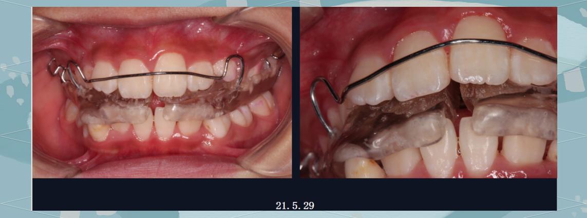 制作肌激动器的具体步骤有哪些？需要准备哪些材料和工具？过程中有哪些关键注意事项需重点关注？-图2