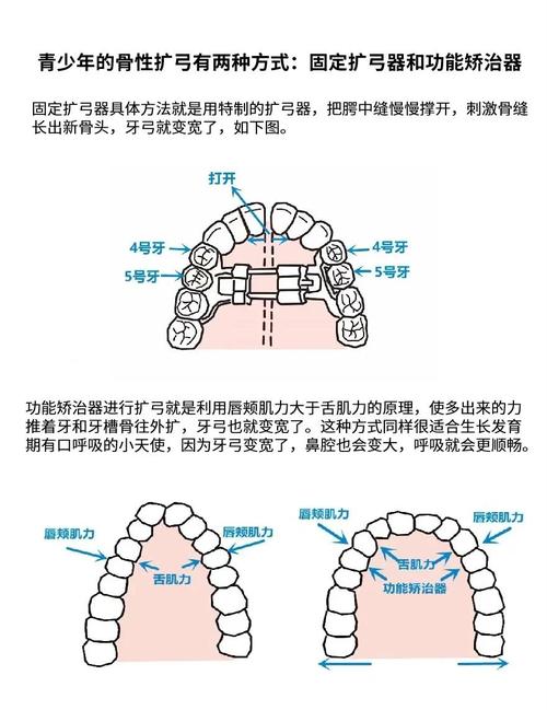 牙齿拥挤有哪些解决方法?传统矫正和隐形矫正哪种更适合自己?矫正后效果能维持多久需要注意什么?-图1 牙齿拥挤有哪些解决方法?传统矫正和隐形矫正哪种更适合自己?矫正后效果能维持多久需要注意什么?-图1