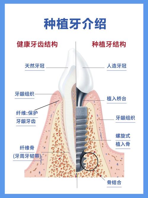 种植牙的具体方法有哪些?不同种植技术(如即刻种植、微创种植等)适用于哪些牙齿缺失情况,患者该如何根据自身条件选择?-图2 种植牙的具体方法有哪些?不同种植技术(如即刻种植、微创种植等)适用于哪些牙齿缺失情况,患者该如何根据自身条件选择?-图2