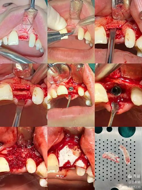 种牙拆完线后为何还需植骨?植骨的必要性、时间安排及术后恢复注意事项有哪些?-图1 种牙拆完线后为何还需植骨?植骨的必要性、时间安排及术后恢复注意事项有哪些?-图1