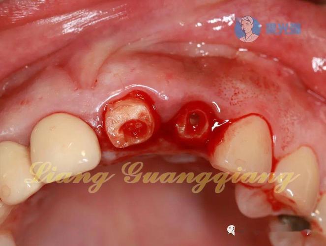 种牙拆完线后为何还需植骨？植骨的必要性、时间安排及术后恢复注意事项有哪些？-图2