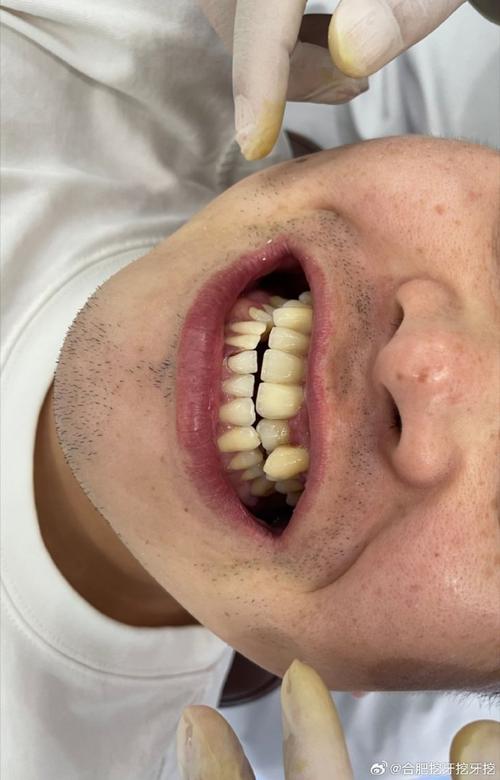 牙周严重到何种程度会让牙医拒绝正畸？背后隐藏着哪些不可忽视的健康风险？-图3