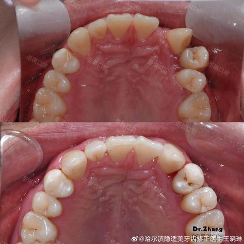 牙周严重到何种程度会让牙医拒绝正畸？背后隐藏着哪些不可忽视的健康风险？-图2