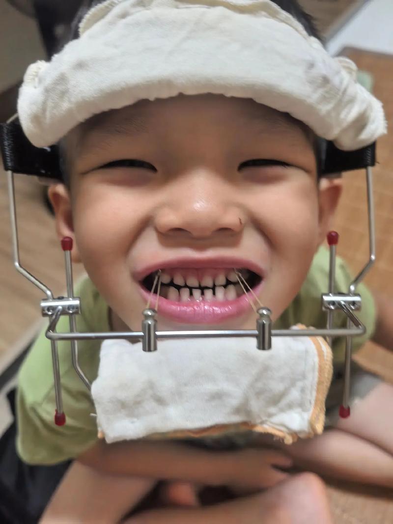 婴儿兜齿（地包天）在婴儿期能矫正吗？有哪些安全有效的方法适合低龄宝宝？-图2