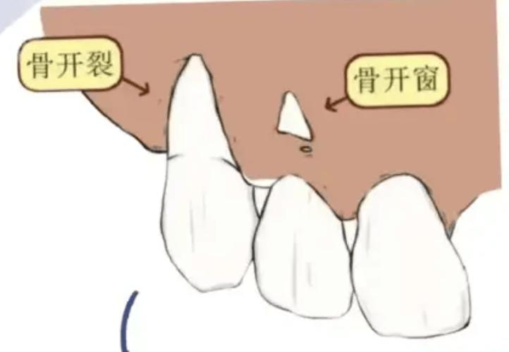 正畸移动前牙牙根的生物学机制是什么?牙根移动方向如何精准控制?-图1 正畸移动前牙牙根的生物学机制是什么?牙根移动方向如何精准控制?-图1