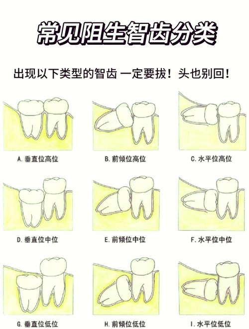 阻生智齿分牙有哪些常用方法?不同阻生类型如何选择最佳分牙方式?效果与术后恢复有何差异?-图1 阻生智齿分牙有哪些常用方法?不同阻生类型如何选择最佳分牙方式?效果与术后恢复有何差异?-图1