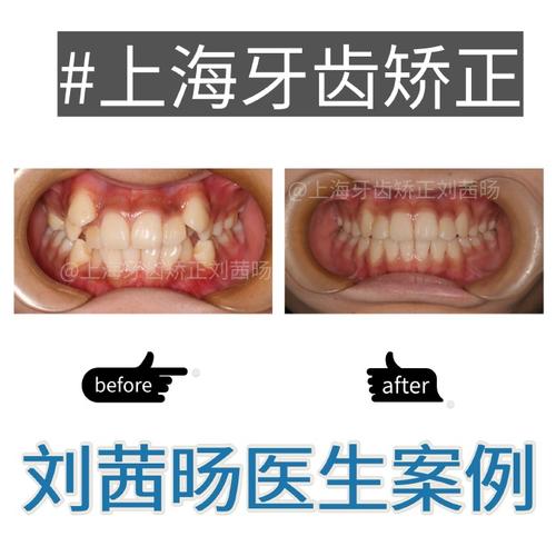 口腔正畸医疗事故鉴定中,如何界定医疗过错与患者自身因素的责任边界?-图3 口腔正畸医疗事故鉴定中,如何界定医疗过错与患者自身因素的责任边界?-图3