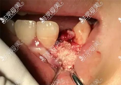 山西口腔医院种牙技术怎么样？种植体品牌、医生资质、价格透明度和术后效果有哪些需要注意的？-图3