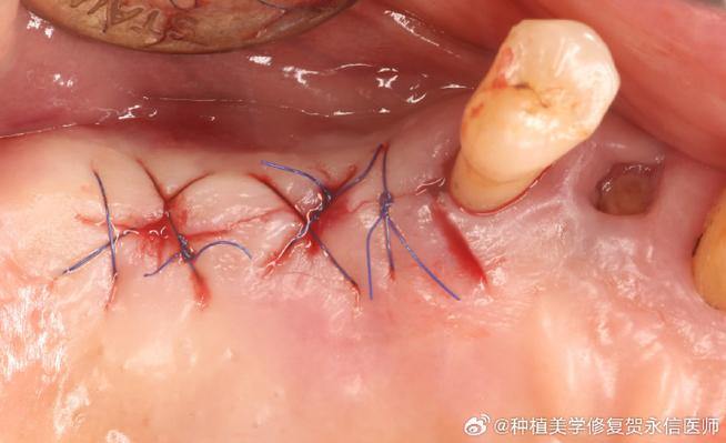 种牙后手术部位出现红肿、疼痛或出血是正常恢复表现吗？术后护理不当会引发哪些并发症？-图2