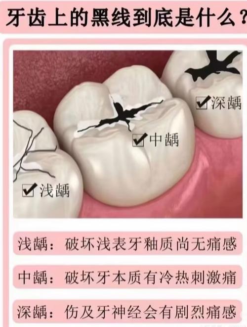 口腔正畸专业是否包含龋齿的诊疗范围？正畸医生能处理患者的龋齿问题吗？-图1