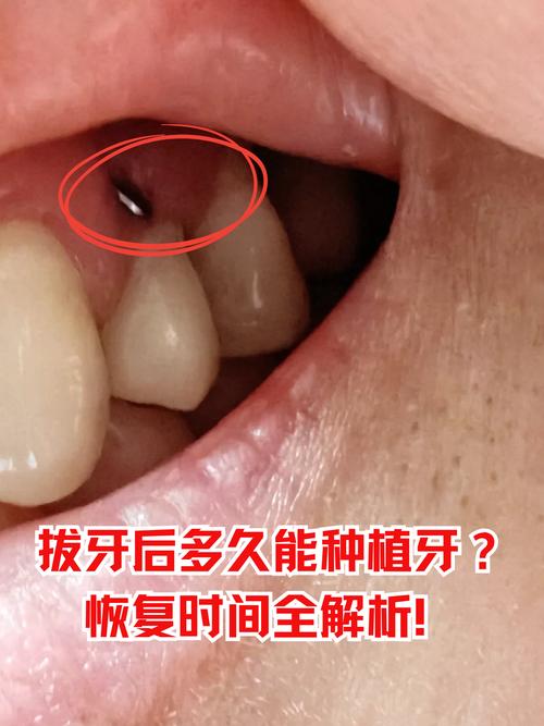 种牙后修复阶段到底会不会疼？疼痛感强不强，有没有办法有效缓解不适？-图2