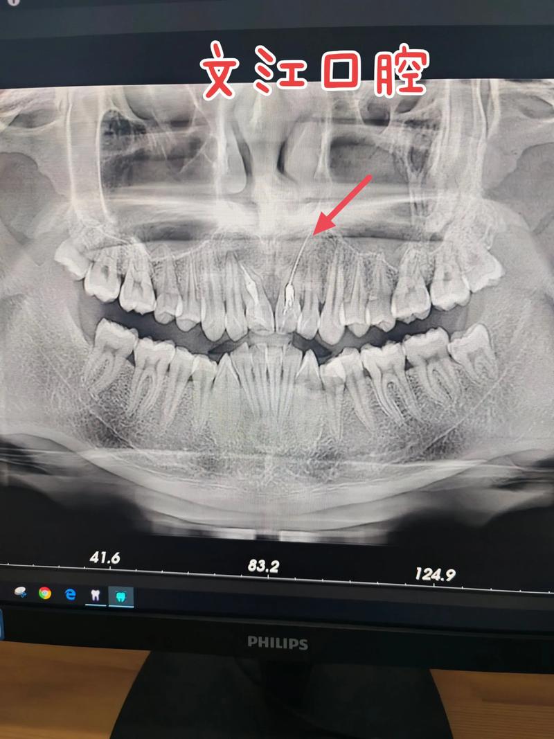 牙CT真的只有一种吗?不同口腔检查需求下,到底有哪些类型的牙CT,它们又有什么技术差异?-图1 牙CT真的只有一种吗?不同口腔检查需求下,到底有哪些类型的牙CT,它们又有什么技术差异?-图1