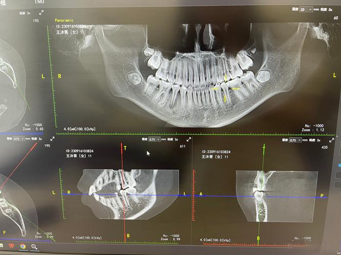 牙CT真的只有一种吗?不同口腔检查需求下,到底有哪些类型的牙CT,它们又有什么技术差异?-图2 牙CT真的只有一种吗?不同口腔检查需求下,到底有哪些类型的牙CT,它们又有什么技术差异?-图2