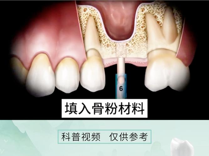 种牙骨是什么意思？牙齿种植前为何需要骨粉填充？作用与具体流程是怎样的？-图1