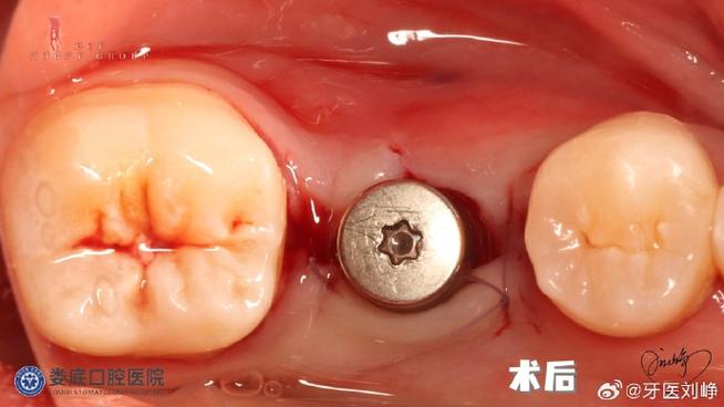 种牙二期手术拆线后需要注意哪些事项？拆线时间有统一标准吗？拆线过程会疼吗？-图2