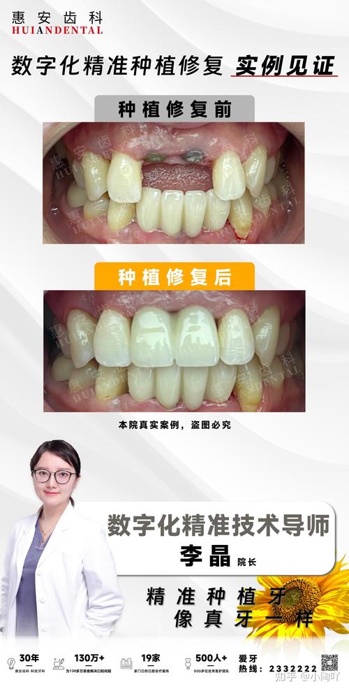 刚种牙后的修复图能直观呈现哪些恢复关键点？种植体周围软组织形态与咬合功能状态如何通过图像评估？-图2