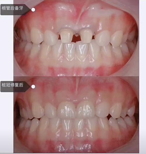 刚种牙后的修复图能直观呈现哪些恢复关键点？种植体周围软组织形态与咬合功能状态如何通过图像评估？-图1