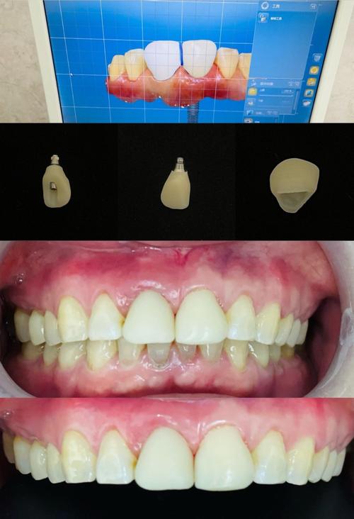 刚种牙后的修复图能直观呈现哪些恢复关键点？种植体周围软组织形态与咬合功能状态如何通过图像评估？-图3