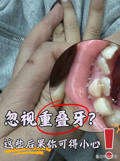 咬合紧为什么会被视为种牙的禁忌？背后存在哪些潜在风险与应对策略？-图2